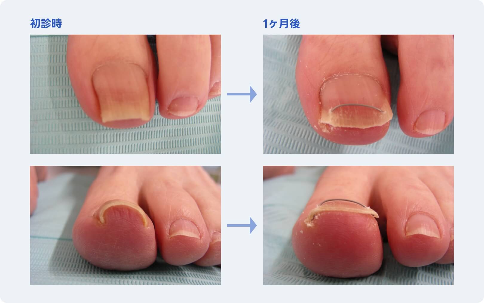 初診時→1ヶ月後